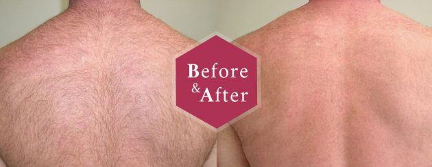 Shoulder Laser Hair Removal: Easier and Quicker than Ever